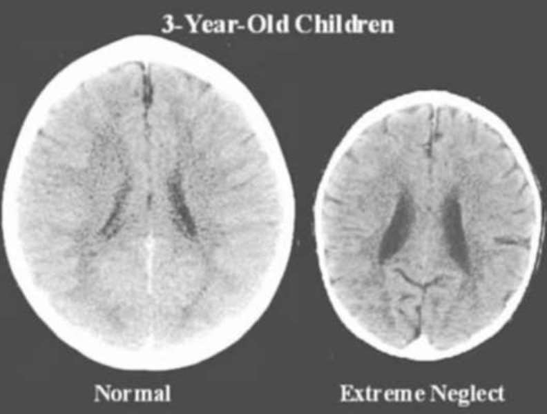 Δείτε τον αντίκτυπο της αγάπης στον εγκέφαλο του παιδιού σε μια συγκλονιστική εγκεφαλική σάρωση
